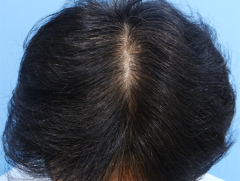 薄毛治療 発毛症例 47歳/O型/8ヶ月後