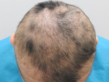 薄毛治療 発毛症例 36歳/全体/初診時